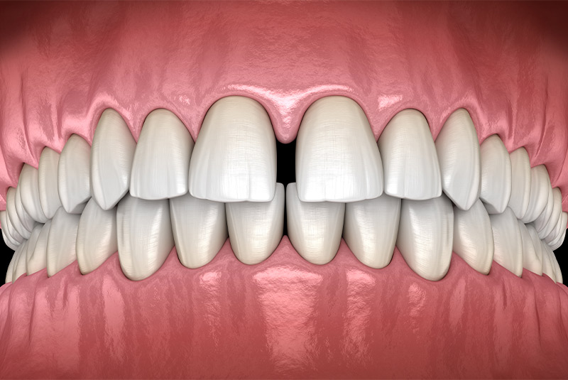 Gapped teeth example model