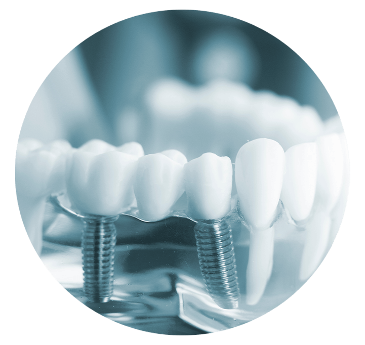 Multiple dental implants