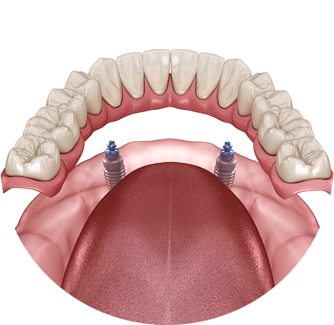 Implant supported dentures example model