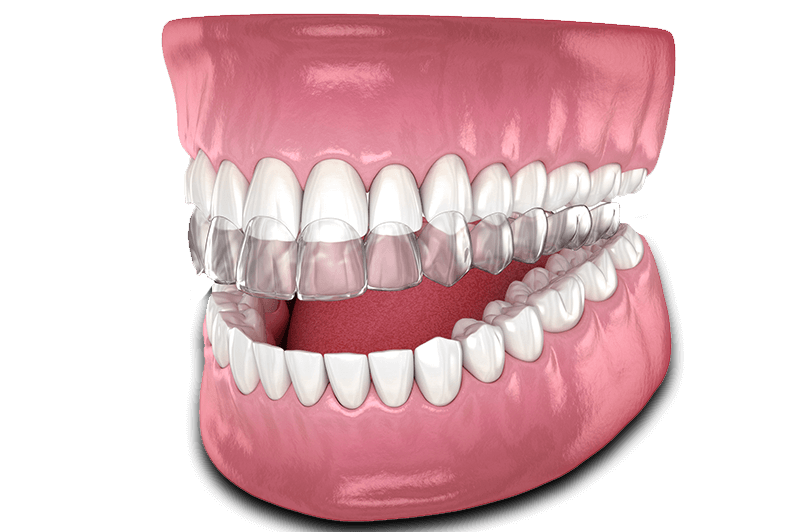 Invisalign example model