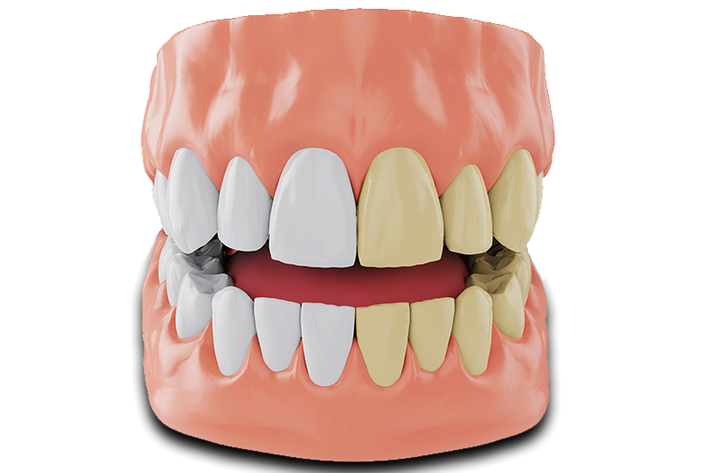 Teeth whitening before and after example model
