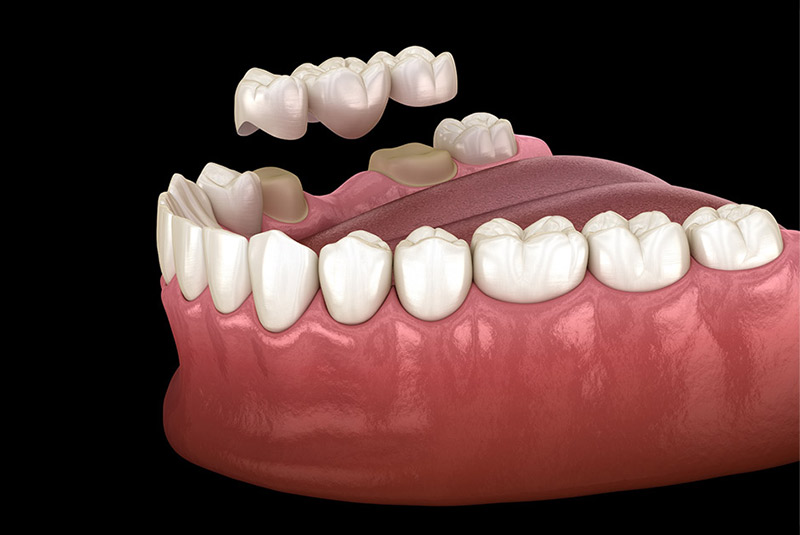 Dental crown example model