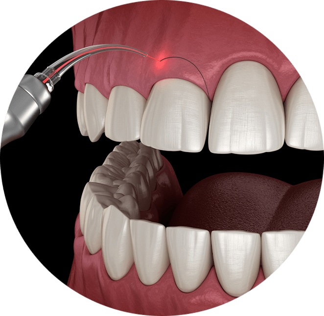 Laser therapy example model