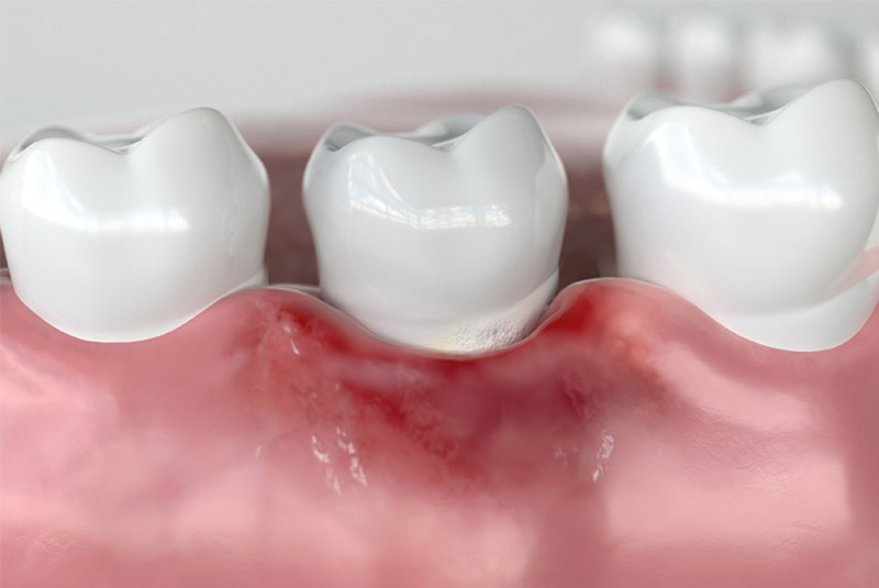 Gum disease example model